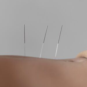 Acupuncture ( séances suivantes)