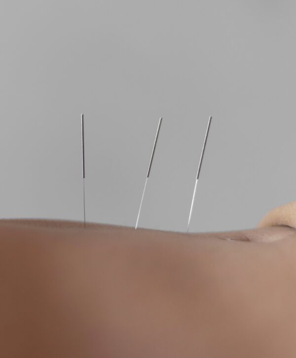 Acupuncture ( séances suivantes)